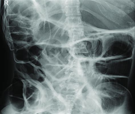 ray   abdomen showing  faecal retention  bowel distension