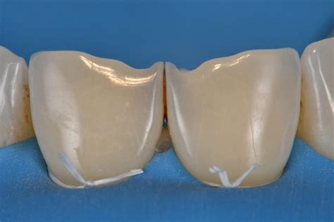 Invisible Composite Restorations To Repair Incisor Fractures