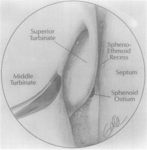 Endoscopic Treatment Of Sphenoid Sinusitis Ralph Metson Richard E