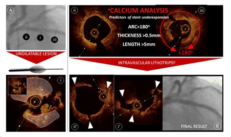 Calcium Modification Guided By Oct Panel A Demonstrates A Severe