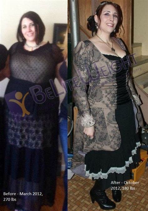 Leslie Before And After Gastric Sleeve Photos And Story Beliteweight Weight Loss Services