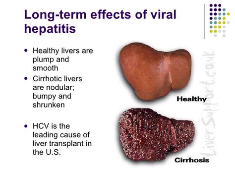 Hepatitis A B C And Hiv Presentation 2011