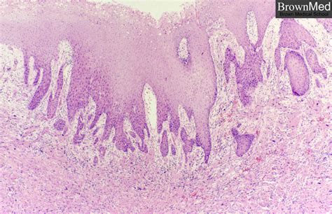 Benigni Benign Throat Tumor