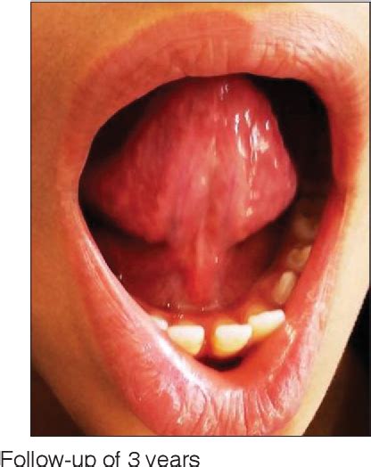 Figure 1 From Labial Ankyloglossia A Rare Case Report Semantic Scholar