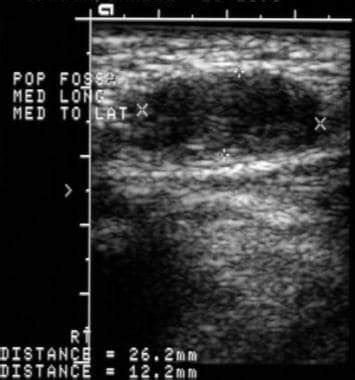 Baker's Cyst On Ultrasound