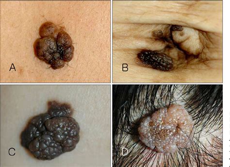 Figure From Four Cases Of Lobulated Intradermal Nevus A Sign Of