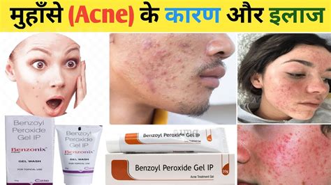 मुहाँसे यानी Acne के कारण और इलाज जड़ से खत्म करें पुरुष और महिला