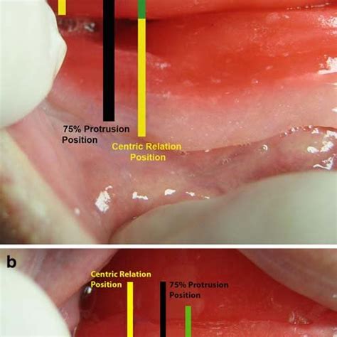 PDF Erratum Management Of Obstructive Sleep Apnea In An Edentulous