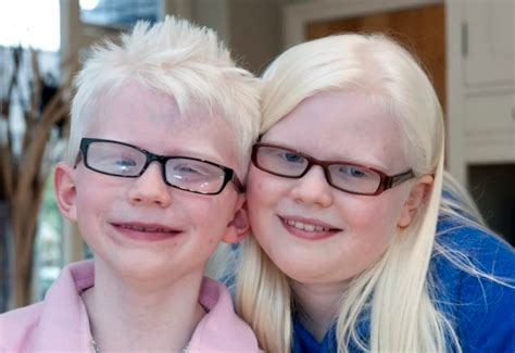 Albinism Genetics