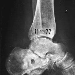 (PDF) Subtalar arthrodesis with correction of deformity after fractures of the os calcis