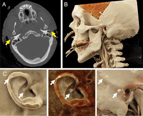 Non Contrast Head Ct Identifies Bilateral Auricular Calcification