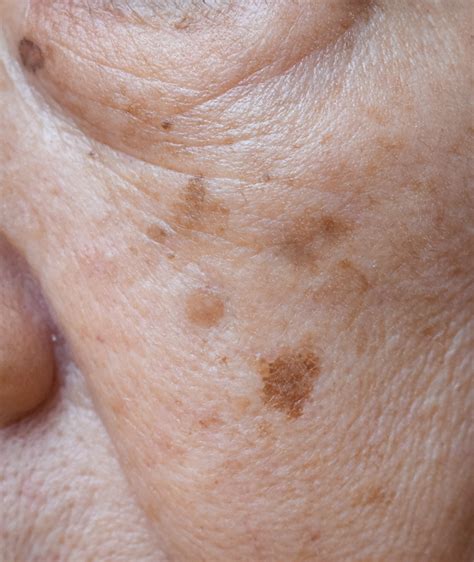 Brown Spots Treatment Mclean Potomac Dermatology