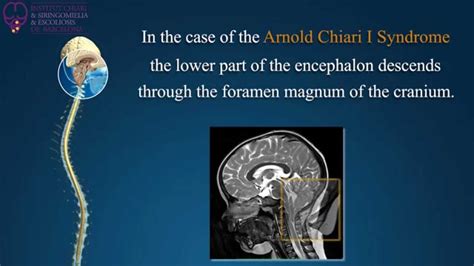 Syringomyelia Scoliosis Arnold Chiari Syndrome Institut Chiari De Barcelona Youtube