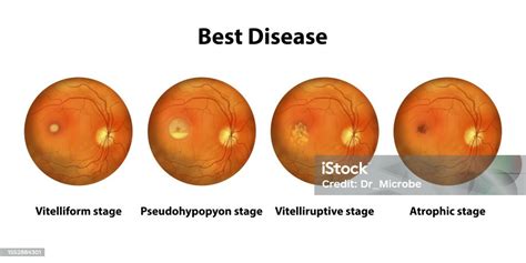 Mejores Etapas De Distrofia Macular Viteliforme Ilustración Científica