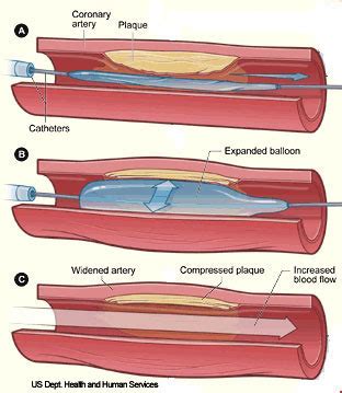 Percuttaneous Transluminal Coronary Angioplasty Diagram Quizlet