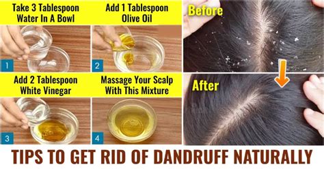 How To Get Rid Of Dandruff Without Shampoo Premier Healthrx