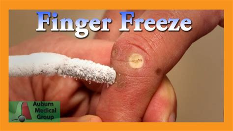 Finger Wart Cryotherapy Probe Auburn Medical Group Youtube