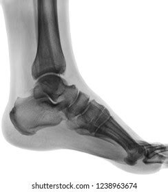 Xray Normal Human Foot Lateral View Foto De Stock Shutterstock