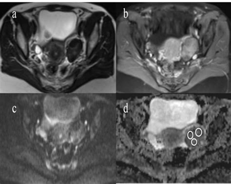 T Weighted Image A Contrast Enhanced Fat Saturated T Weighted