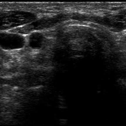 TUS of atrophic thyroiditis (a patient with mild hypothyroidism: TSH ...