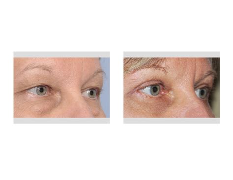 Case Study: Blepharoplasty For Puffy Eyes - Explore Plastic Surgery