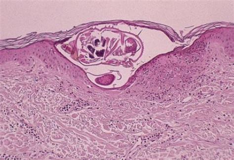 Adult female scabies mite with egg | Medical Laboratories