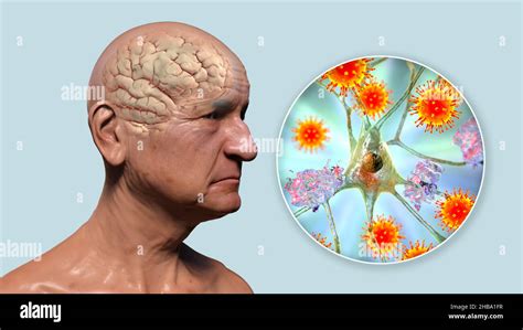 Enfermedad Infecciosa Por Citomegalovirus Fotograf As E Im Genes De