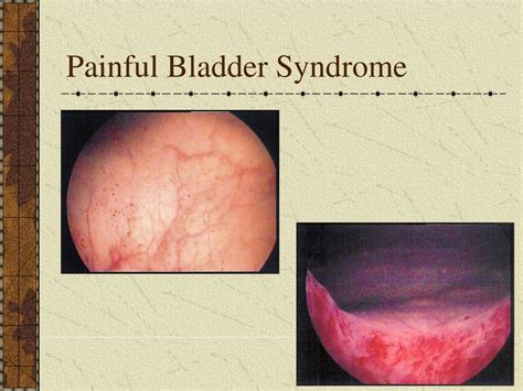 PPT Endoscopy And Radiology For Lower Urinary Tract Dysfunction