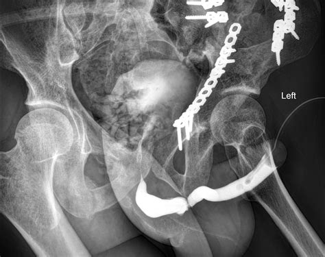 Urethral Stricture Image Radiopaedia Org