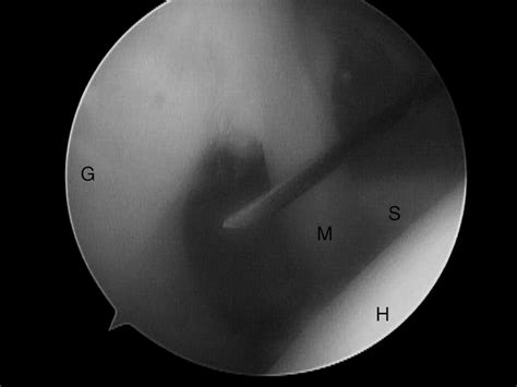 Repair Of Slap Lesions Associated With A Buford Complex A Novel