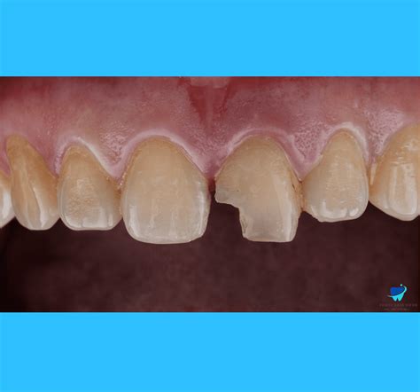 Tooth Discoloration