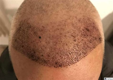 Hair Transplant Crown Take A Look At This Real Life Example Hairpalace