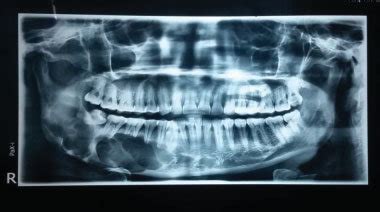 Orthopantomogram Showing A Large Multilocular Radiolucent Lesion With