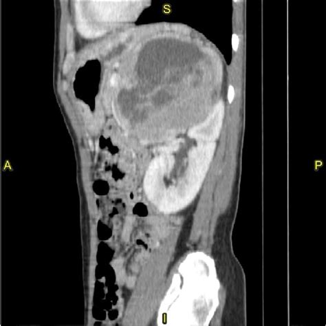 Multiplanar Reconstruction Of A Contrast Enhanced Abdominal Computed