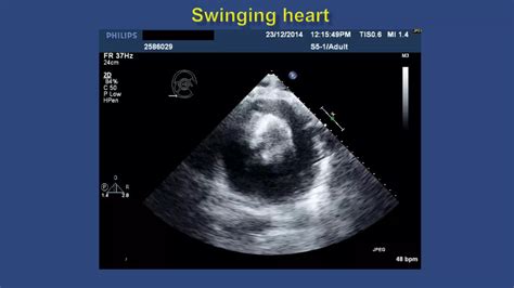 Pericardial Diseases 2020 Final Ppt