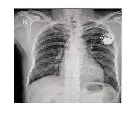 Chest x-ray image of permanent pacemaker implant in body chest ...