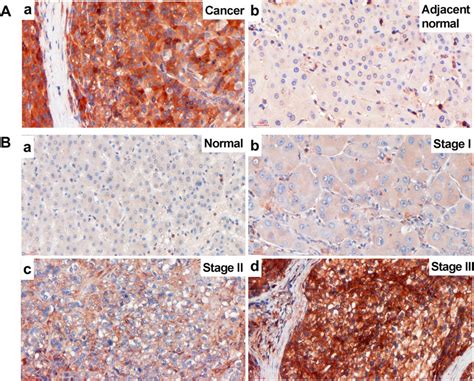 ChREBP Immunohistochemistry In HCC And Normal Liver Tissue A The