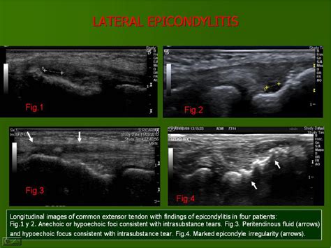 Figure From Ultrasound Of The Elbow What The Radiologist Should