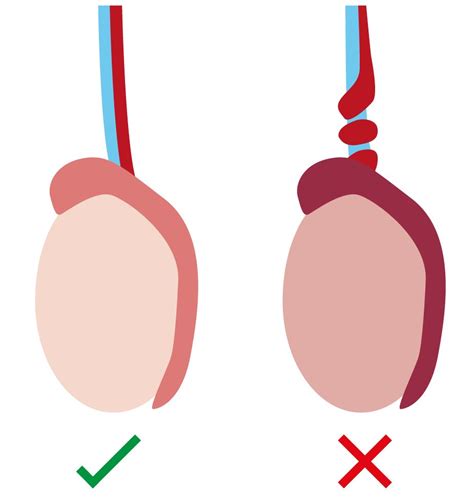 Torsion Of Testicles Twisted Balls Resource Library Sheffield