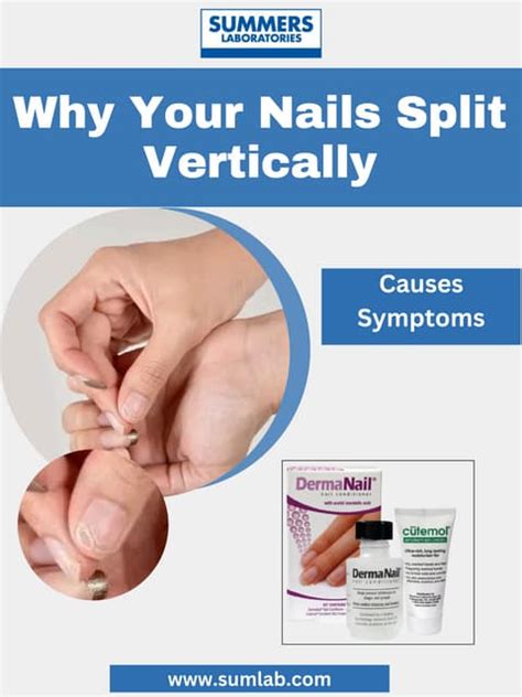 What Deficiency Causes Nails To Split Vertically Pdf