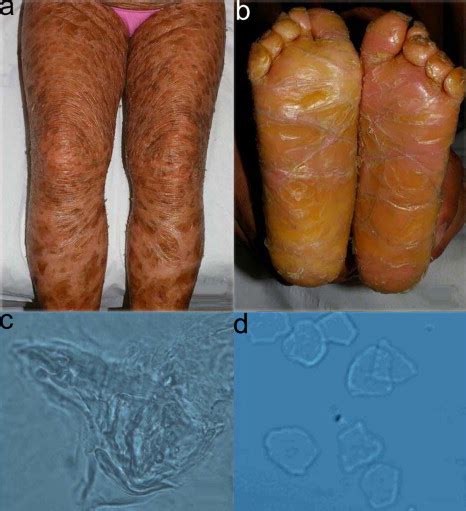 Autosomal Recessive Congenital Ichthyosis And Congenital Hypothyroidism