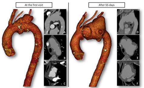 Scielo Brasil Contained Rupture Of An Aortic Arch Aneurysm In A