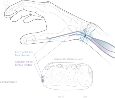 De Quervains Tenosynovitis Sa Hand Therapy