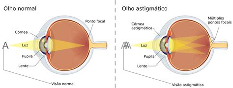 Astigmatismo Sintomi Correzione Con Occhiali O Operazione Laser