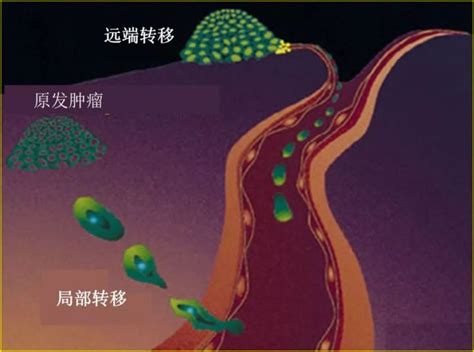 癌症转移 微医（挂号网）