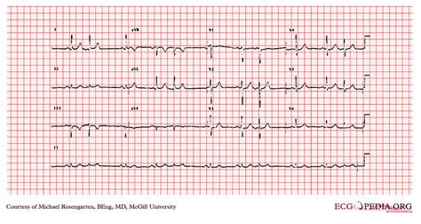 Mcgill Case 287 Ecgpedia