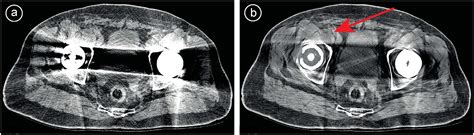 Metal Artifact Reduction Techniques In Musculoskeletal Ct Imaging