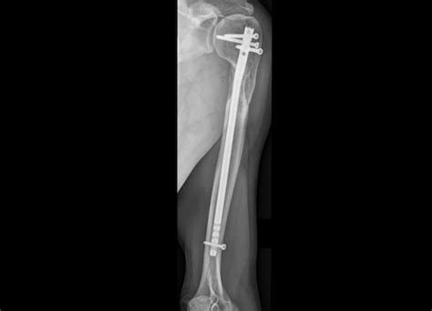 Hanging Cast For Humerus Fracture Therapy – FRACTURE