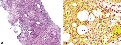 A Retrospective Study Of Idiopathic Granulomatous Mastitis Diagnosis