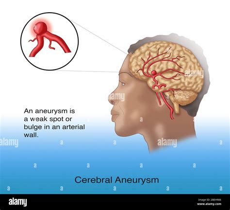 Brain Aneurysm In Situ Stock Photo Alamy